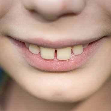 Up-close view of a child’s overbite 