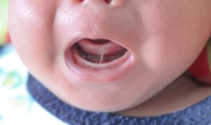 Nose to chin view of a newborn with a tongue tie